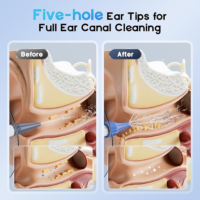 Ear Wax Removal, Electric Ear Cleaning Kit with Light, FSA-HSA-Eligible, Ear Irrigation Kit with 4 Pressure Modes, Safe and Effective Ear Flush Kit with Ear Cleaner - Includes Basin, Towel & 15 Tips