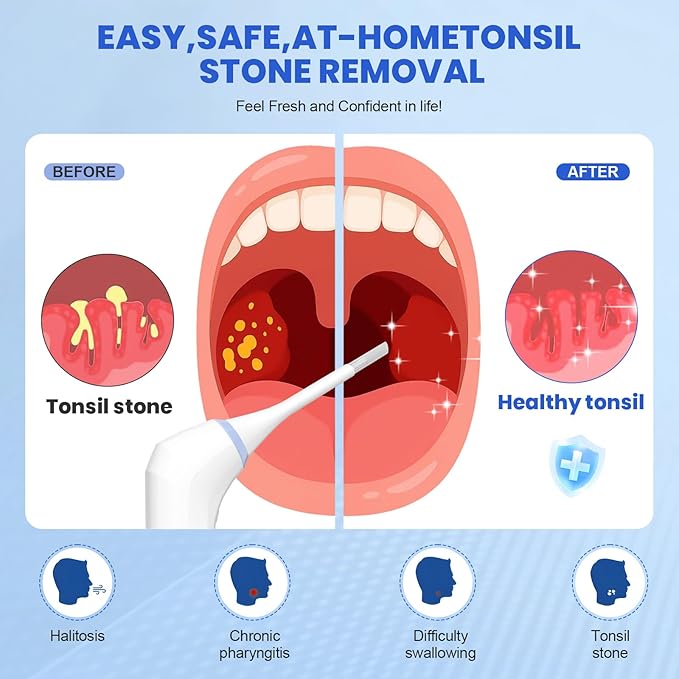Tonsil Stone Remover Tool, Electric Tonsil Stone Removal Kit with LED Light & 3 Suction Levels | Best Tonsil Stone Remover Vacuum, Tonsil Stone Cleaning Device